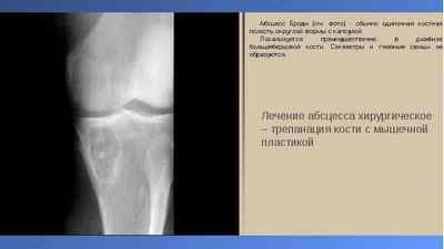 Абсцес Броді великогомілкової кістки: відмітна ознака і лікування операцією, код за МКХ 10 та рентген | Ревматолог