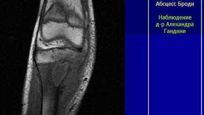 Абсцес Броді великогомілкової кістки: відмітна ознака і лікування операцією, код за МКХ 10 та рентген | Ревматолог