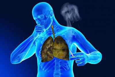 Абсцес легені: що це таке, симптоми, лікування