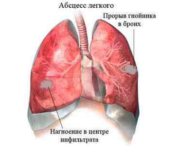 Абсцес легені: що це таке, симптоми, лікування