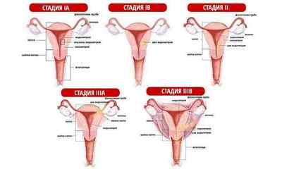 Аденокарцинома матки: причини, симптоми і лікування