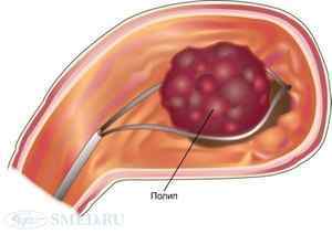 Аденоматозний поліп шлунка: що це, причини, симптоми і методи лікування