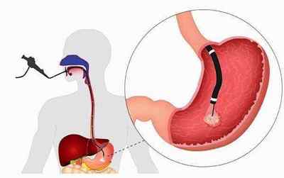 Аденоматозний поліп шлунка: що це, причини, симптоми і методи лікування