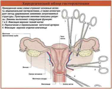 Аденоміоз матки: що це таке, симптоми і лікування