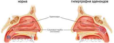 Аденотомия (видалення аденоїдів): показання, способи, хід, реабілітація