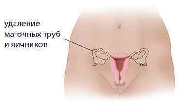 Аднексектомія (операція видалення придатків матки): показання, хід, реабілітація