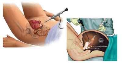 Аднексектомія (операція видалення придатків матки): показання, хід, реабілітація