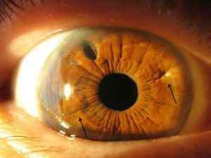 Афакія очі: ознаки, фото, симптоми і причини