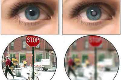 Афакія очі: ознаки, фото, симптоми і причини