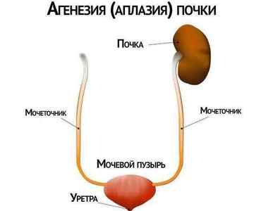 Агенезія (аплазія) лівої і правої нирки у плода