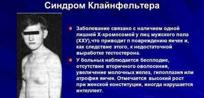 Акромегалія: причини і симптоми захворювання