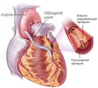 АКШ, аортокоронарне шунтування: операція на серці