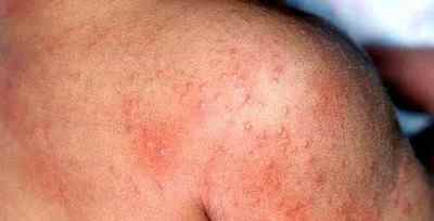 Алергічний дерматит: ознаки, як вилікувати?
