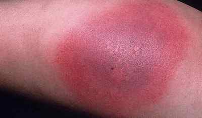 Алергічний дерматит: ознаки, як вилікувати?