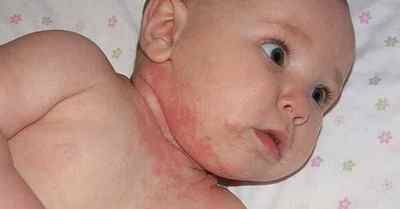 Алергічний дерматит у дітей (лікування і сімптомип)
