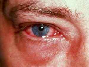 Алергічний набряк повік: лікування очей, причини, симптоми