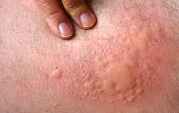 Алергія на чихуахуа