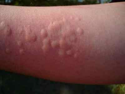 Алергія на Діаскінтест