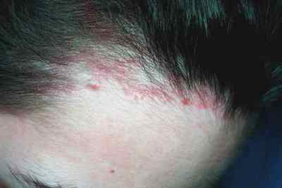 Алергія на фарбу для волосся