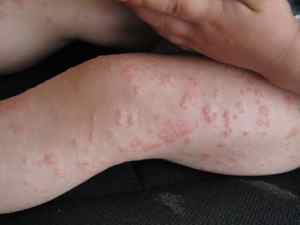 Алергія на фолієву кислоту