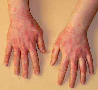 Алергія на латекс