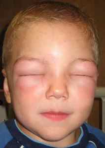 Алергія на лідокаїн