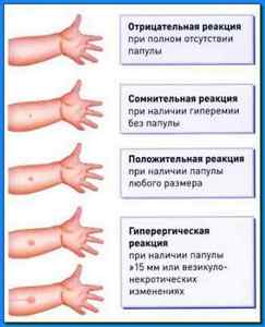 Алергія на Манту: причини, симптоми і лікування