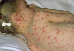 Алергія на парацетамол