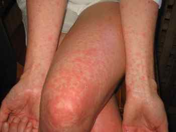 Алергія на пилових кліщів: лікування та профілактика