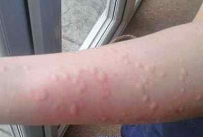 Алергія на порошок