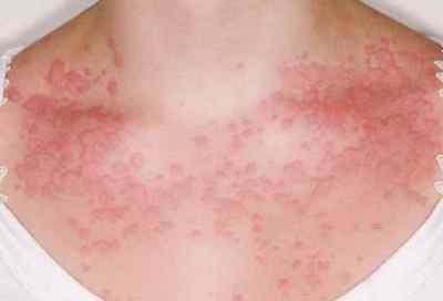 Алергія на постільну білизну