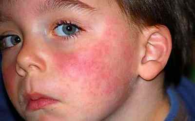Алергія на сонце у дитини - симптоми хвороби, ніж лікувати