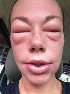 Алергія на укус оси