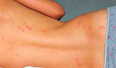 Алергія на укуси бліх