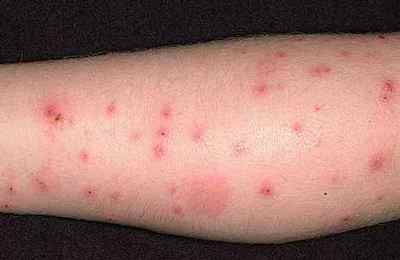 Алергія на укуси бліх