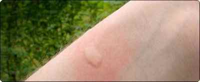 Алергія на укуси комах
