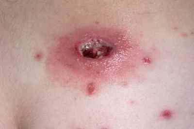 Алергія на знеболюючі препарати