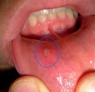 Алергія на зубну пасту
