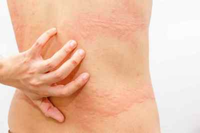 Алергія і свербіж на шкірі: причини і лікування.