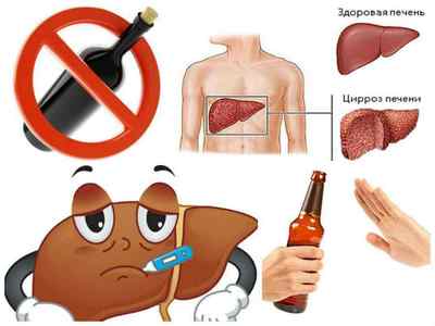 Алкогольний цироз печінки: симптоми і ознаки у алкоголіків, лікування патології від алкоголю