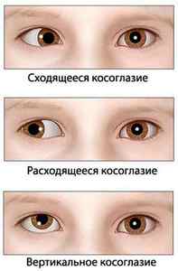 Амбліопія (ледачий очей), лікування діагнозу істеричної амбліопії у дорослих