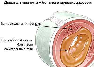 Амбробене: інструкція із застосування сиропу, розчину і таблеток