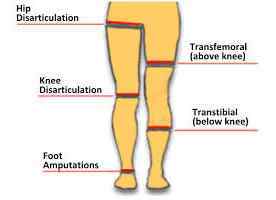 Ампутація ноги (нижніх кінцівок), стопи, стегна, гомілки, пальця