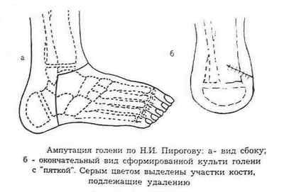 Ампутація ноги (нижніх кінцівок), стопи, стегна, гомілки, пальця
