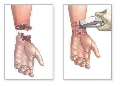 Ампутація пальця ноги і руки (стопи і кисті), фаланг