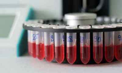 Аналіз крові на цитомегаловірус: здача і розшифровка результатів