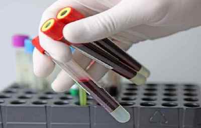 Аналіз крові на ВІЛ як здається натщесерце чи ні