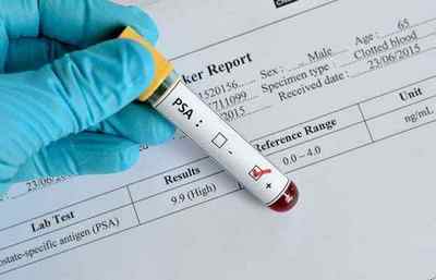 Аналіз крові ПСА та його розшифровка
