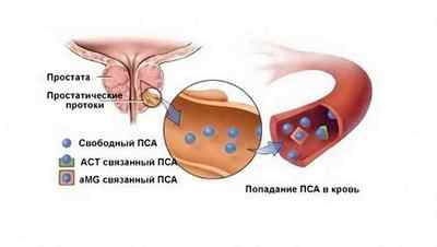 Аналіз на ПСА при аденомі передміхурової залози