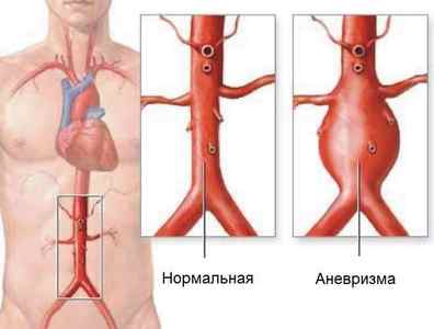 Аневризма аорти черевної порожнини